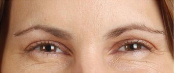 Botox after 391577