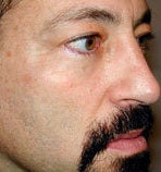 Mid facelift with tear trough implant after 87079