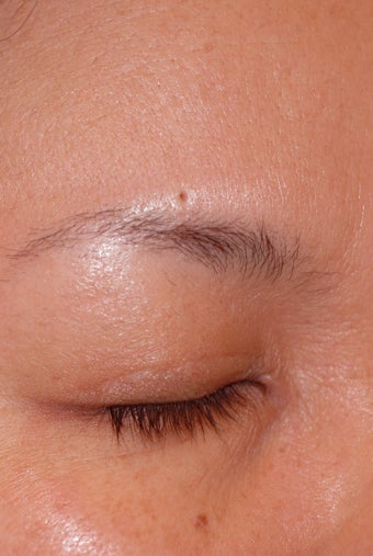 Skin Tag Removal Before Photo after 614134