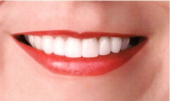 Smile Makeover after 508493