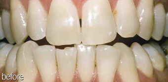 Teeth whitening genetic before 234636