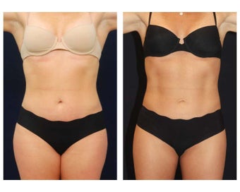 Liposuction before 286774