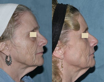 Fraxel repair with C02/Erbium lasers for upper lip wrinkles before 104334