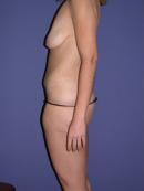 Body Lift before 329947