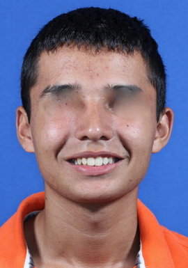 nasal airway surgery with cosmetic improvement after 478799