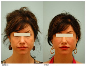Injectable Fillers (Restylane/Perlane) before 136771
