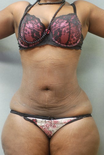 Upper and lower Abdomen & Flanks after 346579