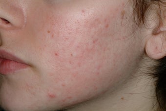 Acne and Isolaz after 95913