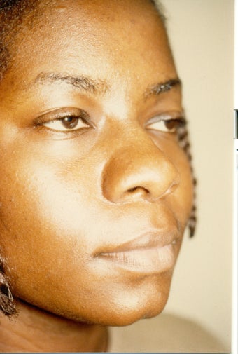 Rhinoplasty before 383006