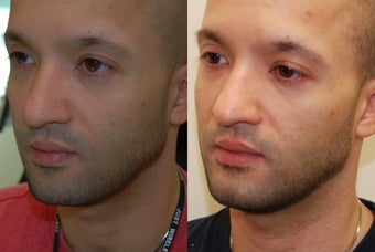 Correction of a crooked Chin Implant with Silikon-1000 before 425357