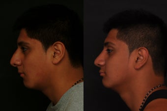 Rhinoplasty 305996