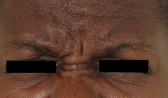 Botox before 378210