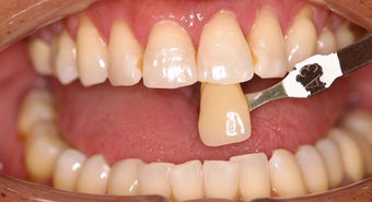Deep bleaching after 306930