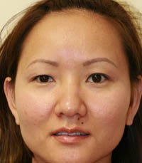 blepharoplasty (eyelids) before 219356