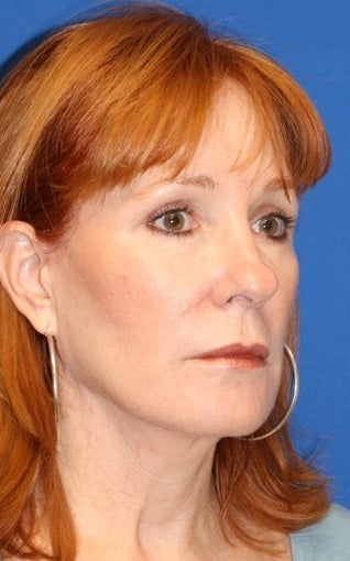 2 years post op: Facelift, Lower Eyelid Skin Pinch, and Peri-orbital Fat Transfer 424184