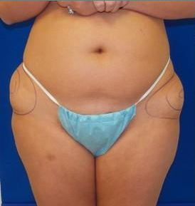 Laser Liposuction before 220308