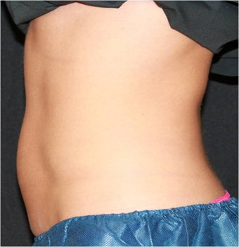 CoolSculpting 420663