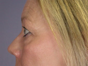 Eyelid Surgery before 306432