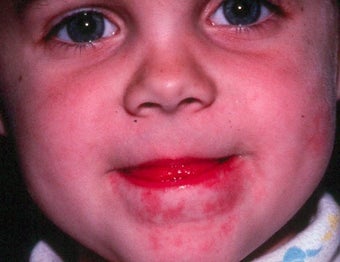 PDL for port wine stain after 374570
