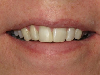Teeth Bonding after 424481