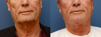 Necklift before 359782
