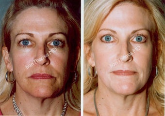 Non-Surgical Face Lift- Exoderm before 242971