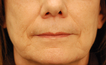 Restylane injectable filler 82770