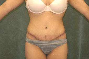 Women's Tummy Tuck Revision after 558745