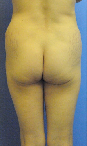 Liposuction and Abdominoplasty before 555498
