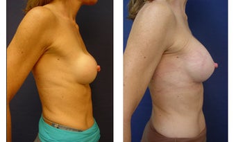Breast implant correction 399965