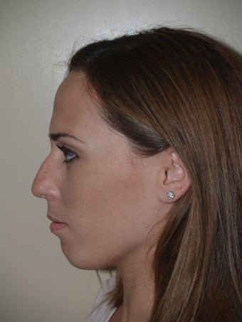 Rhinoplasty before 229068