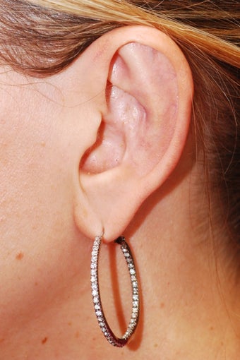 Otoplasty 604375