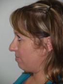 Revision Rhinoplasty 333807