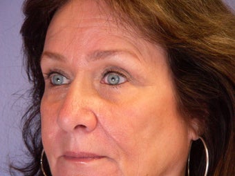 Eyelid Surgery after 306443