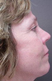 Wrinkle Removal after 550454