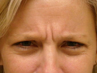 Botox Cosmetic before 375186