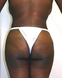 Liposuction and Buttock augmentation after 577820