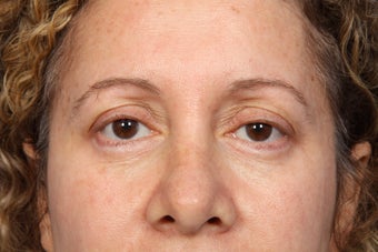 Eyelid Surgery after 306456