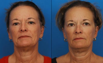 Ultherapy before 411578