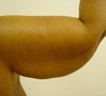 BRACHIOPLASTY (ARM LIFT) before 490940