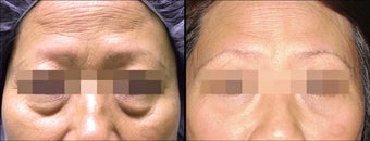 Lower Eyelid(Blepharoplasty) Surgery before 650500
