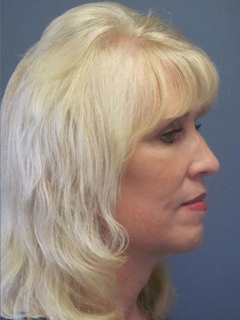 Neck Lift, Platysmaplasty 634754