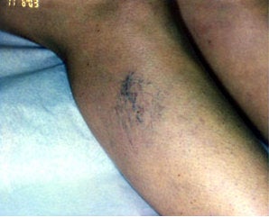 Sclerotherapy before 391581
