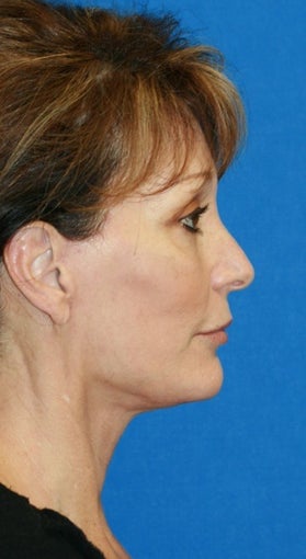 Facelift with Extended Necklift and Upper Blepharoplasty 641627