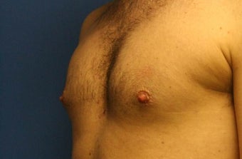 Smart-Lipo of the Chest, Liposuction, Gynecomastia 402440