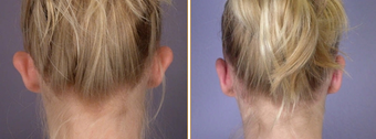 Ear Surgery before 272295