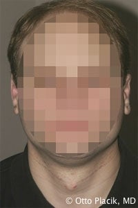 Otoplasty after 567309