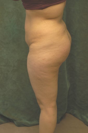 Buttocks Augmentation after 518110
