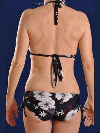 Vaser Hi Def Liposuction of chest, abdomen, back and flanks after 422725