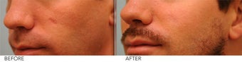 Scar Revision after 361411